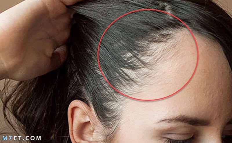 Hair spaces due to dandruff
