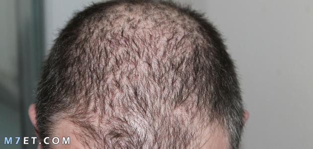 Hair spaces due to dandruff, causes of hair loss and methods of treatment