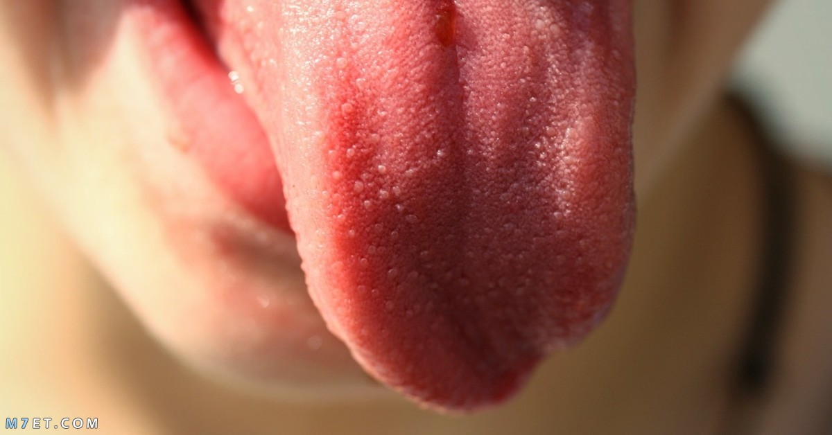 Methods of treating tongue fungus in children