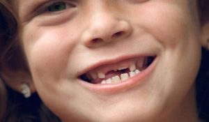 Teeth replacement in children