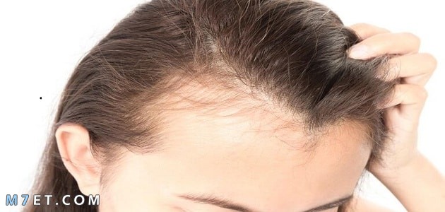 Hair spaces due to dandruff