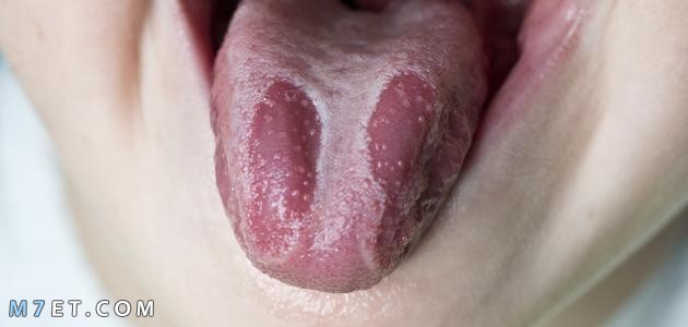 Tongue fungus in children