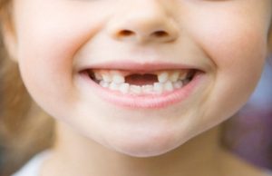 Teeth replacement in children
